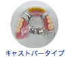 キャストバータイプ義歯